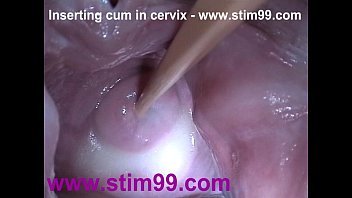 Cervix stretching wide with