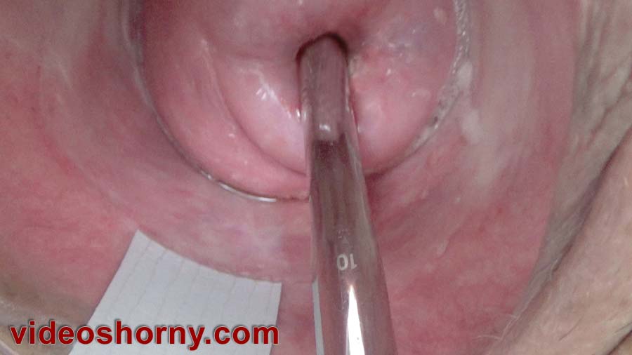 Camera cervix