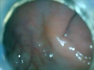 best of Anal endoscope